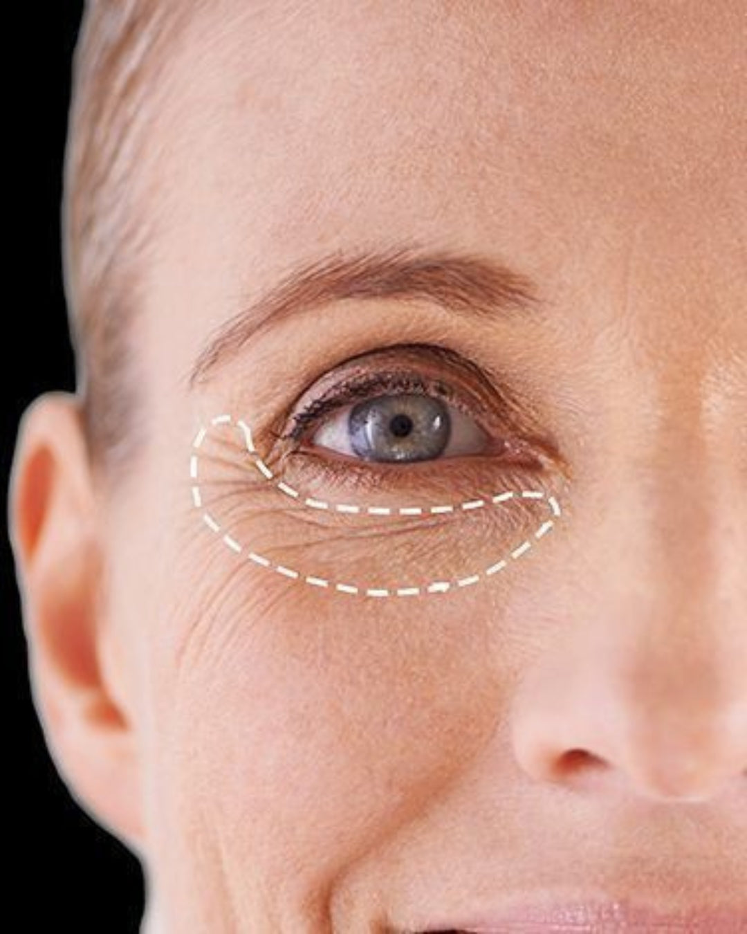 Zona periocular y edema malar