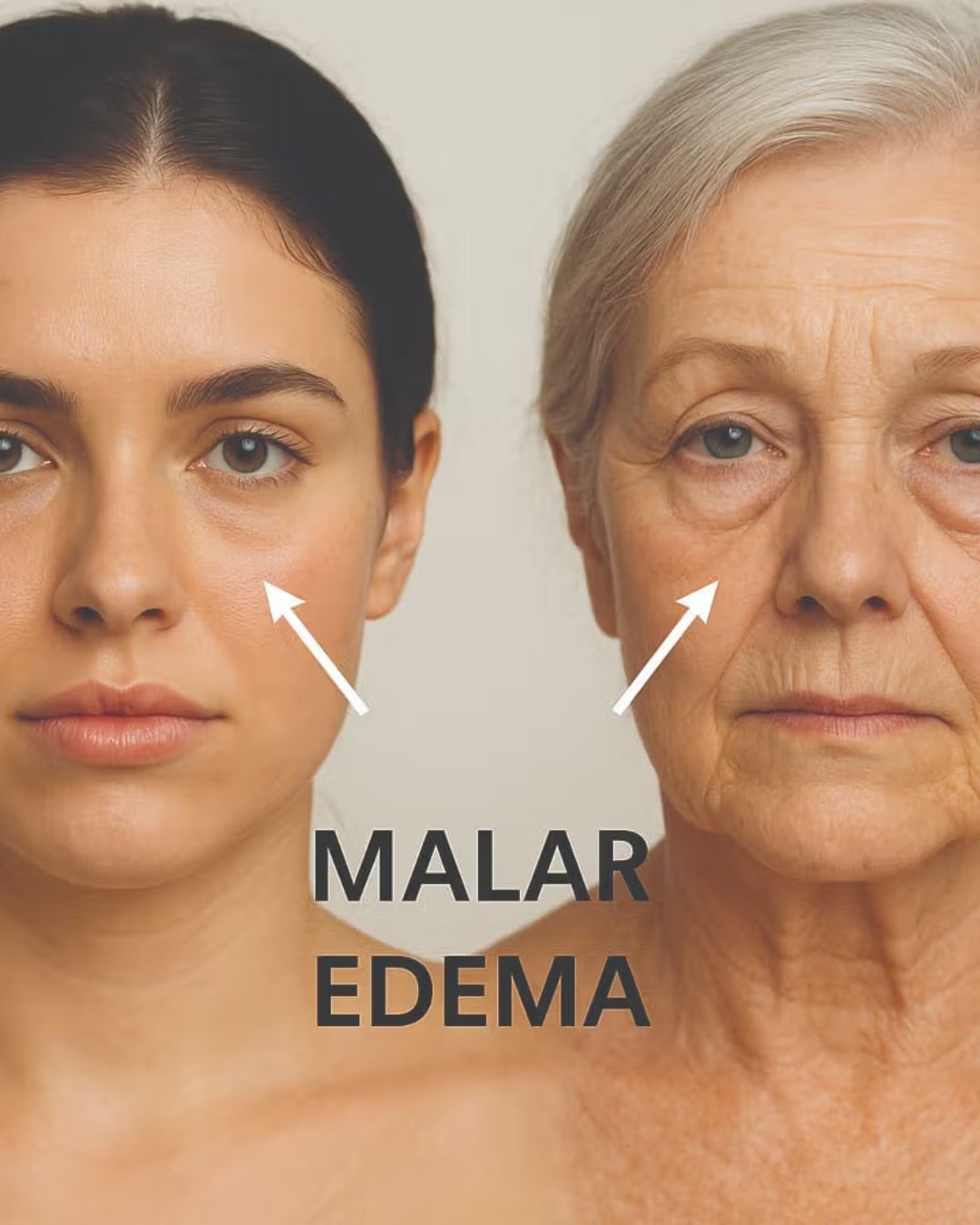 Zona periocular y edema malar